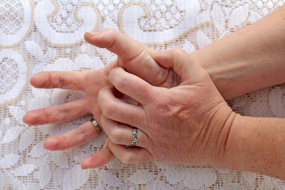 ilustrasi dermatitis tangan (medicalnewstoday.com)