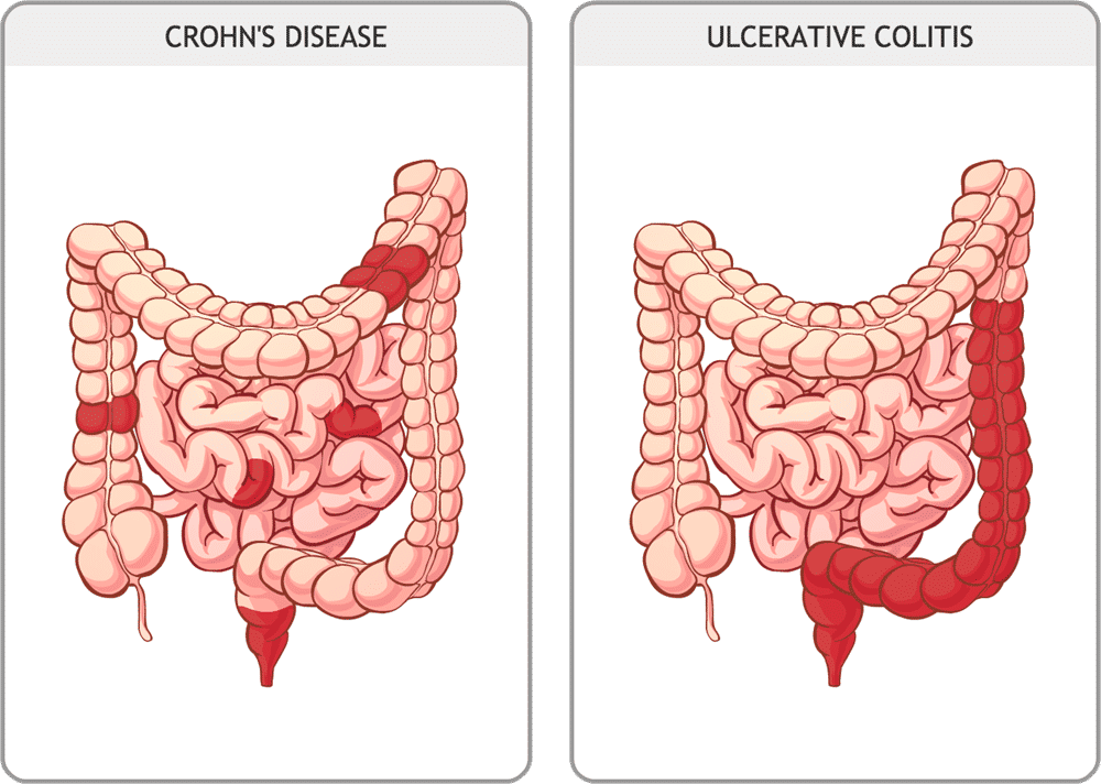 Perbedaan antara kolitis ulseratif dan penyakit Crohn. (aboutkidshealth.ca)