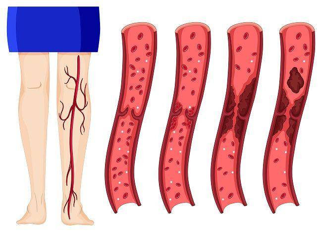 ilustrasi pembekuan darah di kaki (freepik.com/brgfx)