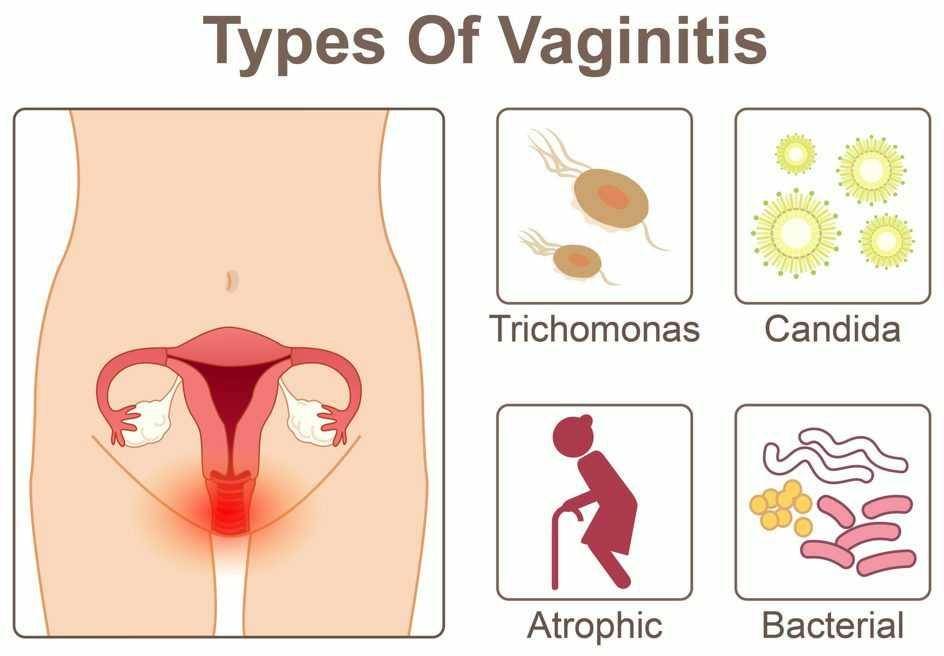 ilustrasi jenis vaginitis (thehealthysteps.com)