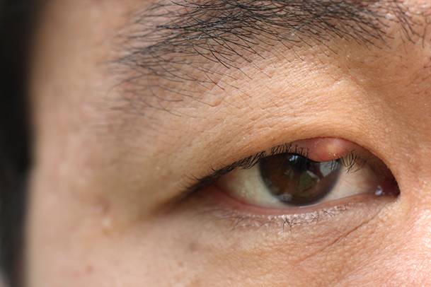 Bintitan menjadi salah satu komplikasi dari blefaritis. (nhs.uk)