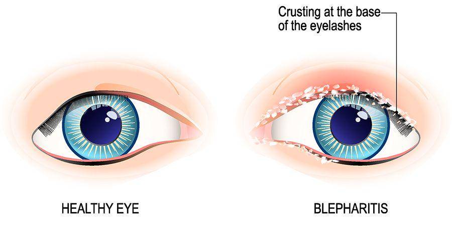 ilustrasi blefaritis (aoa.org)