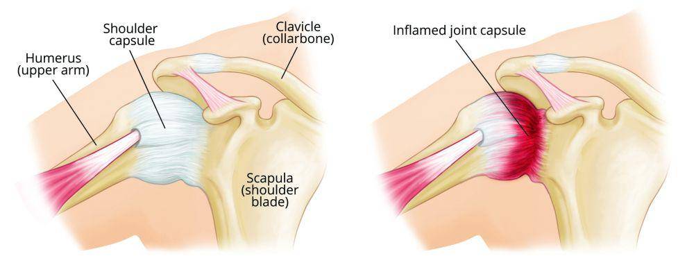 ilustrasi frozen shoulder (orthoinfo.aaos.org)
