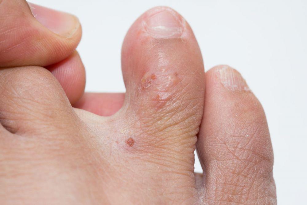 Eksim dishidrotik. nationaleczema.org