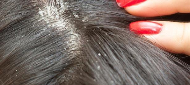 Dermatitis seboroik. nationaleczema.org