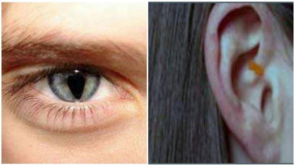 Ilustrasi pasien dengan sindrom mata kucing atau cat eye syndrome. saspjournals.com/Ghizlane El Mghari, Bahia Habra , Sana Rafi, Nawal El Ansari