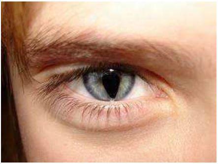 Mengenal Cat Eye Syndrome, Kelainan Mata Mirip Mata Kucing