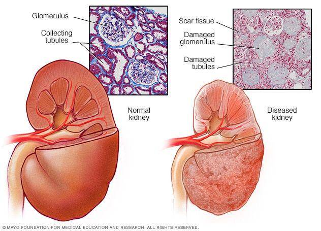 ilustrasi kerusakan pada ginjal (mayoclinic.org)