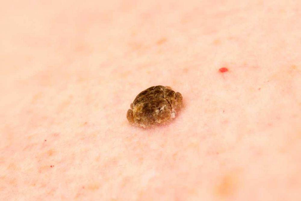 ilustrasi keratosis serboroik (integrityskin.com)
