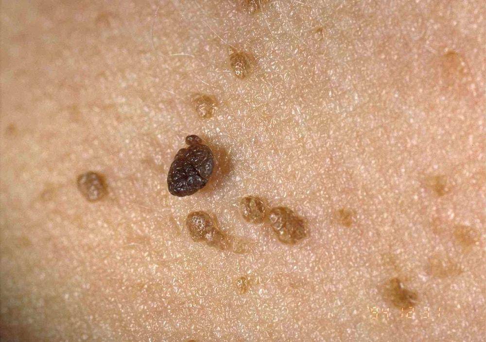 ilustrasi keratosis seboroik (verywellhealth.com)