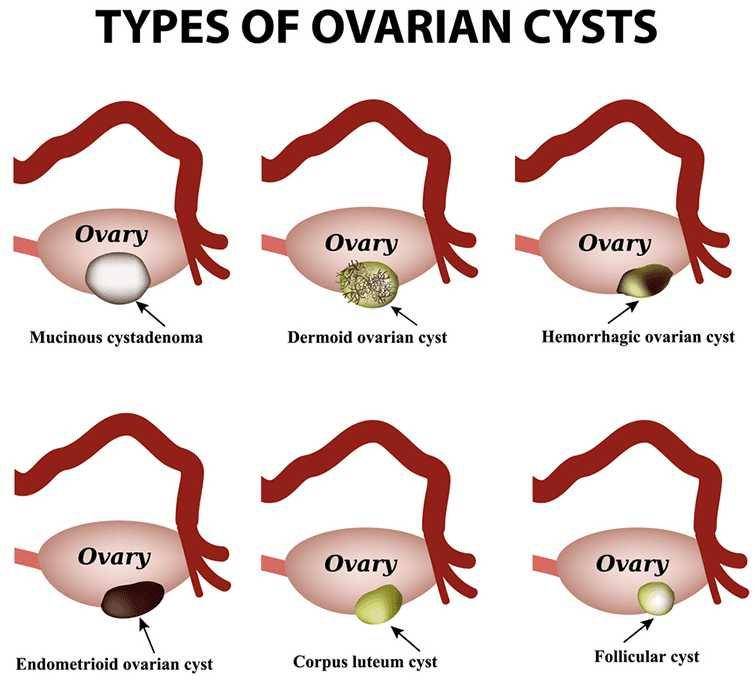 ilustrasi jenis kista ovarium (vilabin.com)
