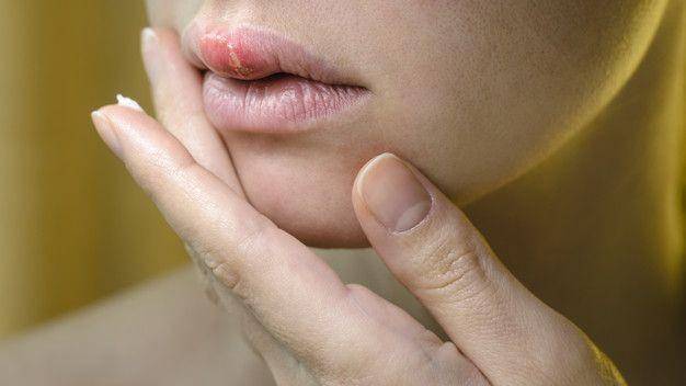 ilustrasi herpes zoster di bibir (freepik.com/v_sot)
