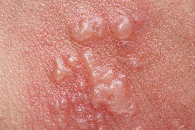 ilustrasi herpes zoster di kulit tangan (freepik.com/toa55)