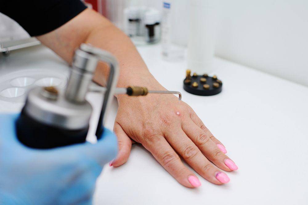 ilustrasi cryosurgery (sccsmd.com)