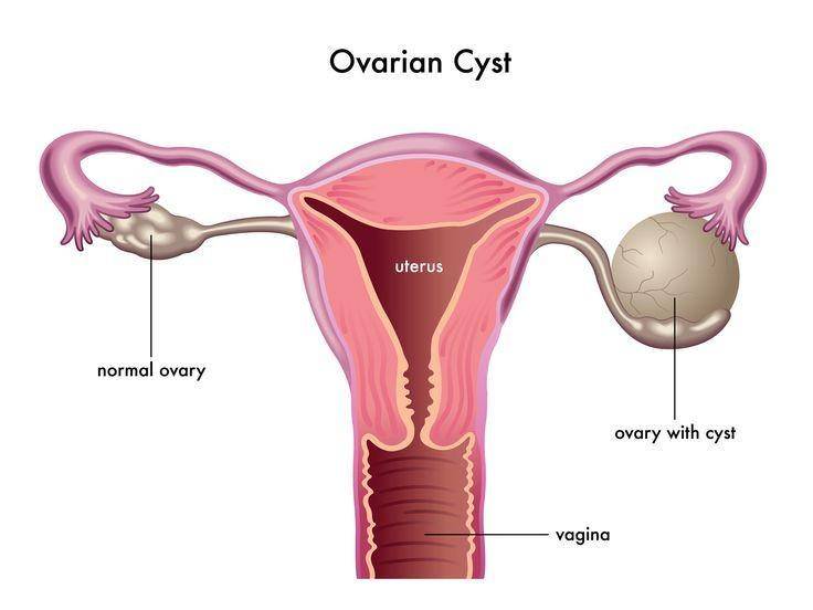ilustrasi kista ovarium (completewomencare.com)