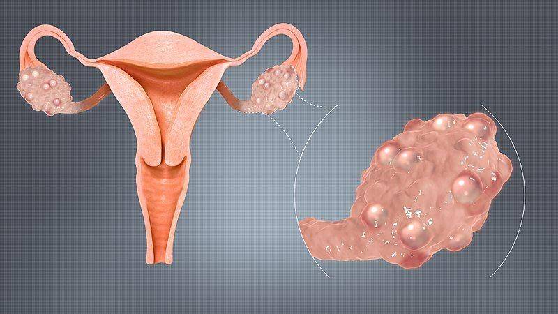 ilustrasi sindrom ovarium polikistik atau PCOS (commons.wikimedia.org/manu5)