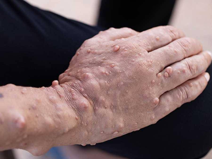 ilustrasi neurofibromatosis (uab.edu)