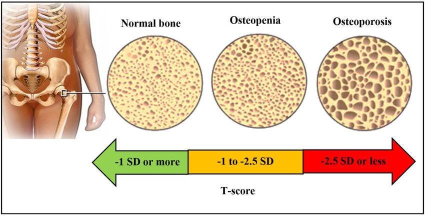 ilustrasi osteopenia (researchgate.net)