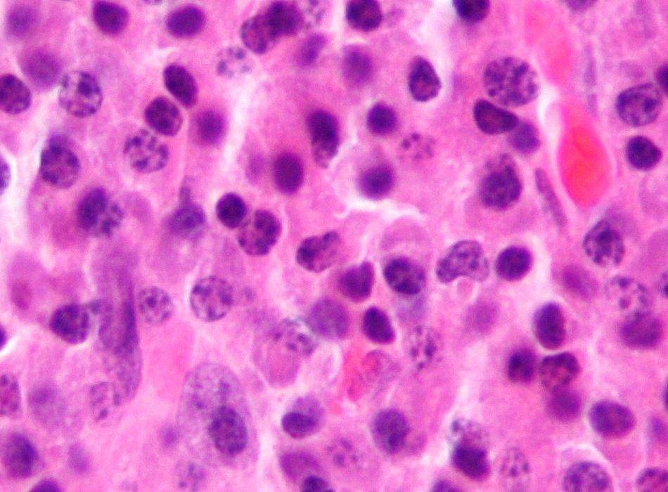 plasmasitoma pada penderita multiple myeloma di bawah mikroskop (wikimedia.org)