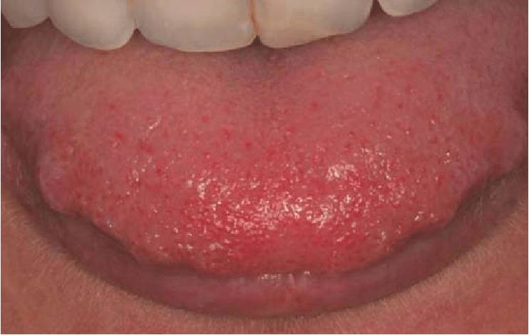 ilustrasi scalloped tongue atau lidah bergigi (researchgate.net/Henry Fergus Duncan)
