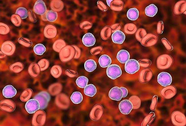 jenis-jenis sindrom mielodisplasia (medicinenet.com)