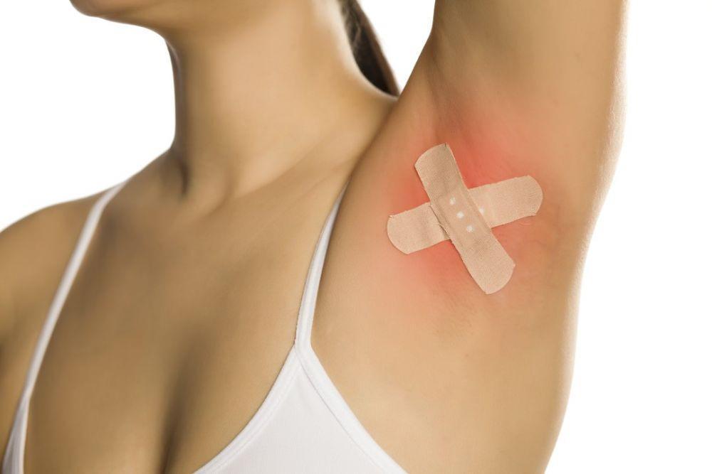 Hidradenitis Suppurativa, Benjolan Menyakitkan di Area Lipatan Kulit