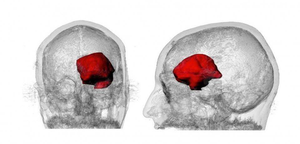 ilustrasi tumor otak (flickr.com/Sarah Colon)
