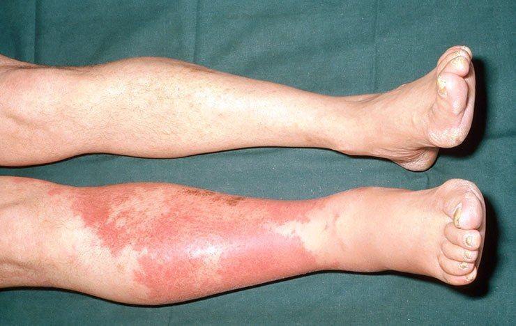 Selulitis: Penyebab, Jenis, Gejala, Komplikasi, Pengobatan