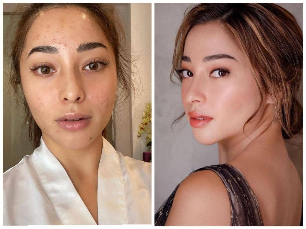 10 Potret Nikita Willy Saat Jerawatan, Sampai Ngerasa Minder!