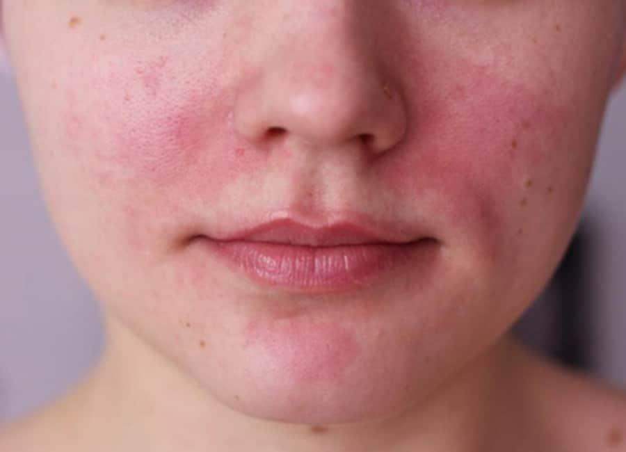 Rosacea: Penyebab, Gejala, Diagnosis, dan Pengobatan