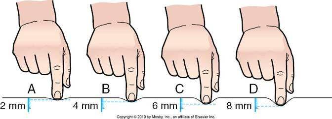 penilaian atau skala pitting edema (tdmuv.com)