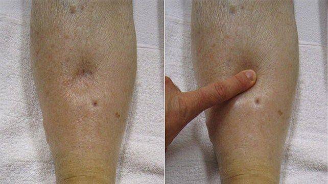 pitting edema (healthline.com)