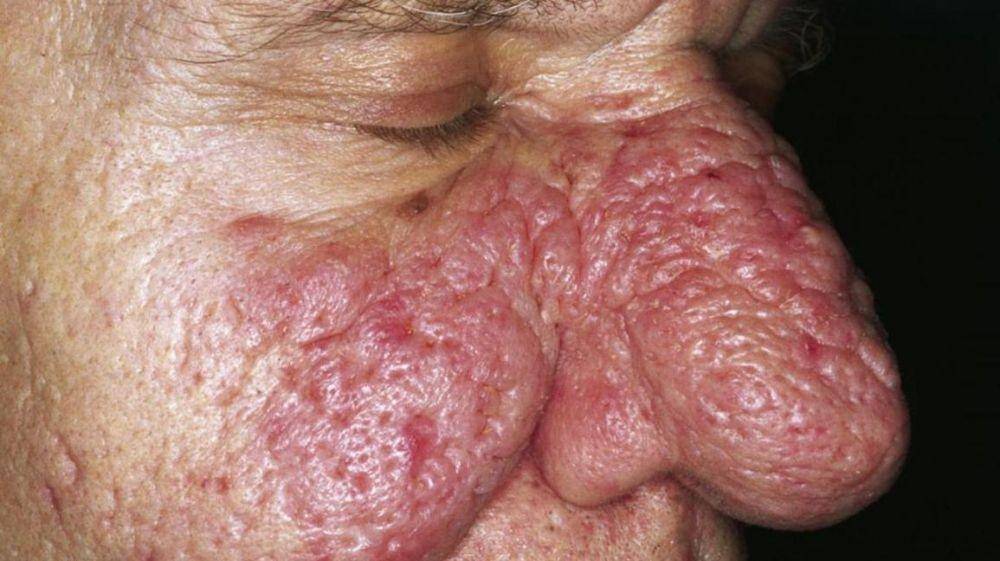ilustrasi rosasea jenis rhinophyma atau subtipe 3 (medicalnewstoday.com)
