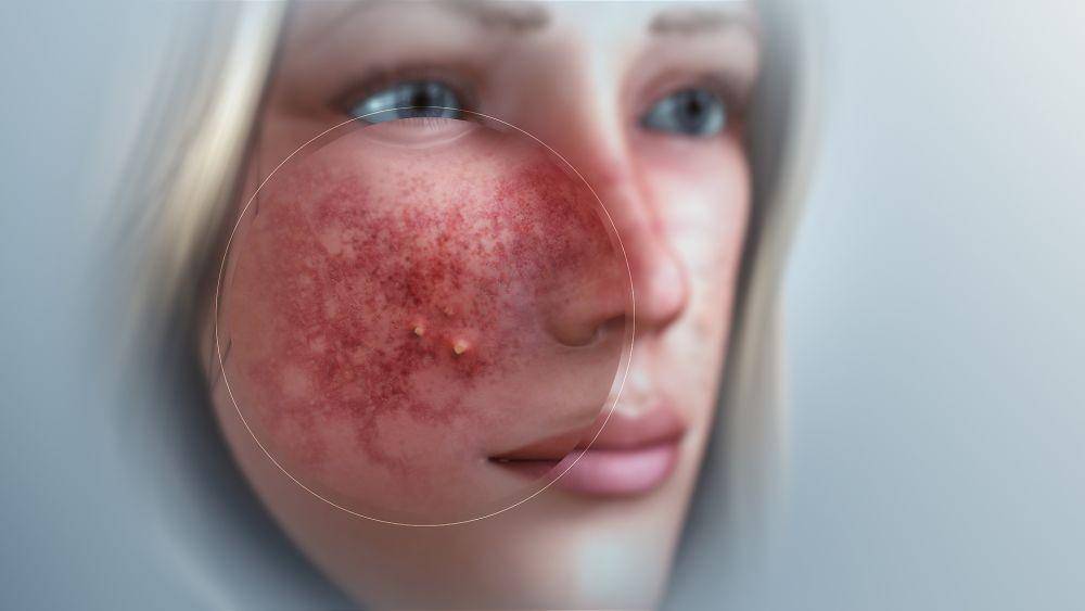 ilustrasi rosacea (scientificanimations.com)
