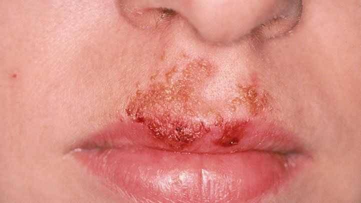 ilustrasi impetigo di bawah hidung (everydayhealth.com)