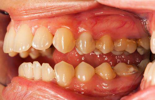 ilustrasi gingivitus (irishhealth.com)
