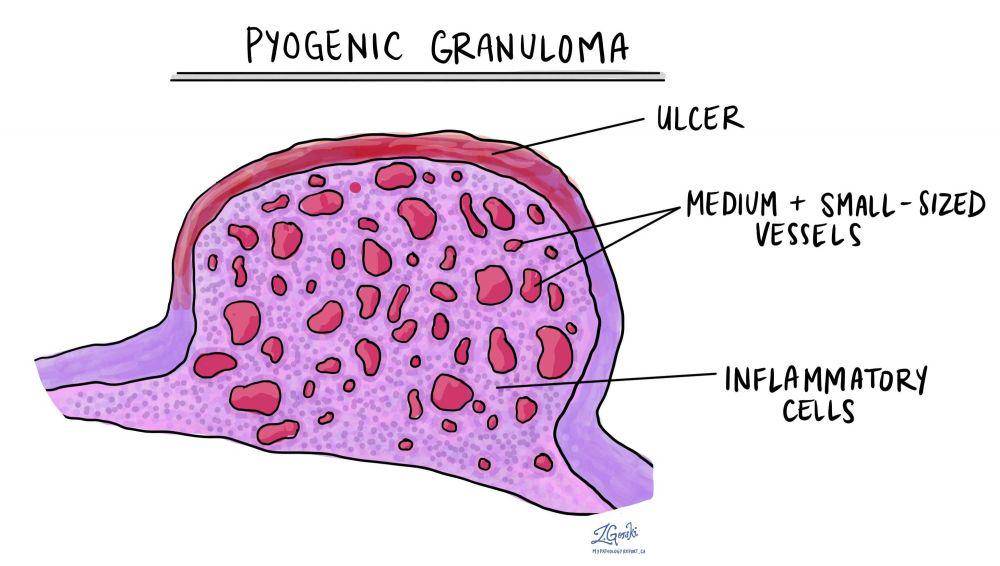 ilustrasi jaringan granuloma pyogenic (mypathologyreport.ca)