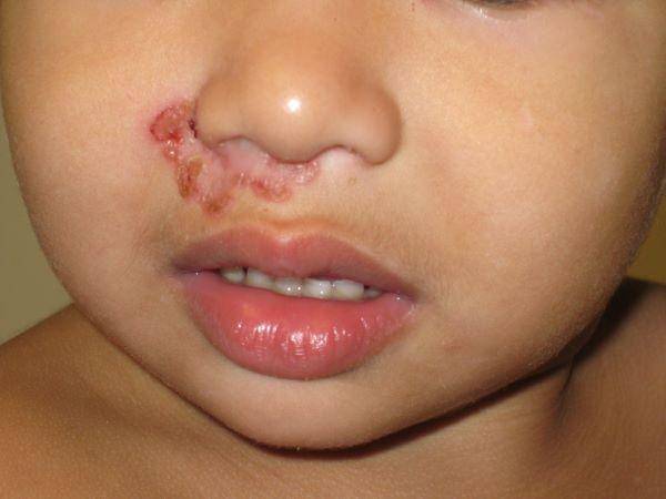ilustrasi impetigo (msdmanuals.com)