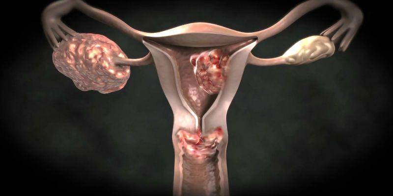 ilustrasi kanker vagina (healthreflect.com)