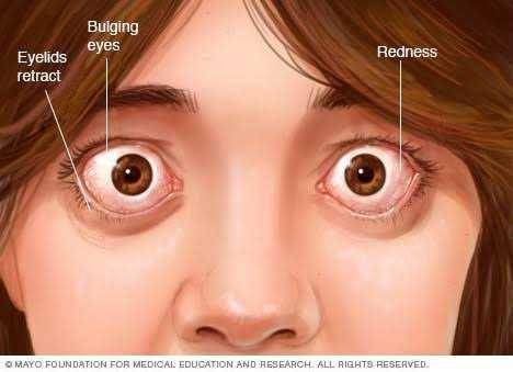 ilustrasi penyakit Graves (mayoclinic.com)