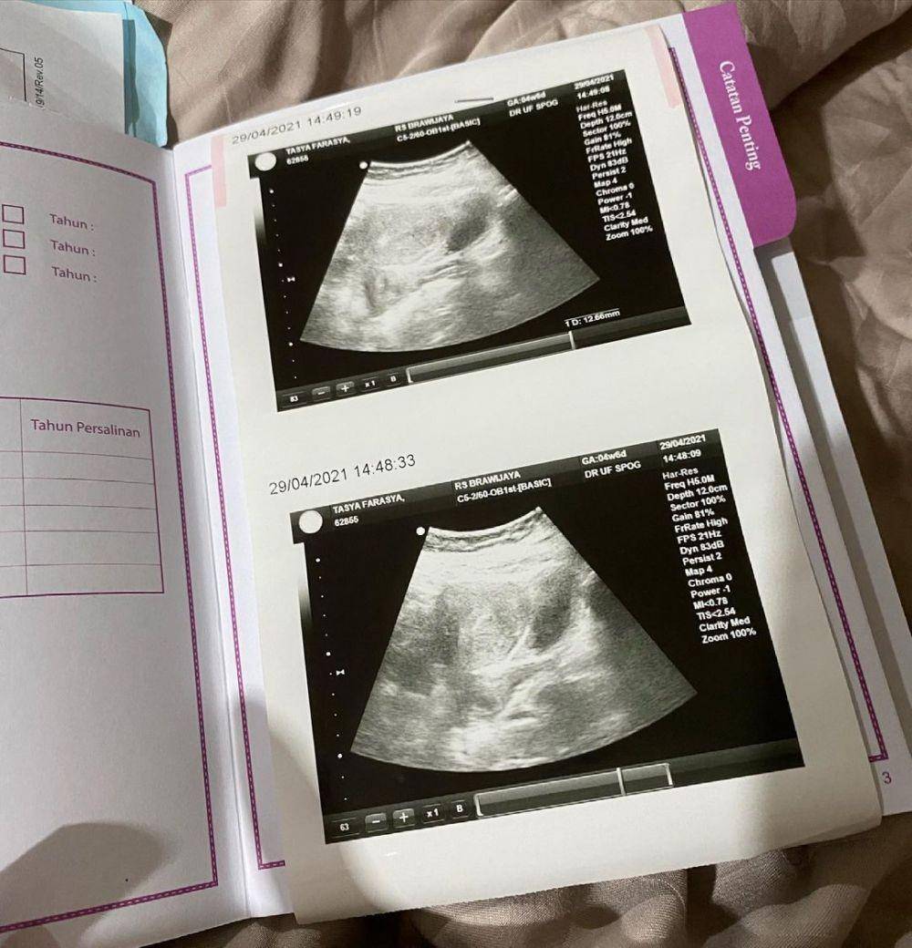 hasil USG yang diunggah Tasya Farasya di Instagram(instagram.com/tasyafarasya)