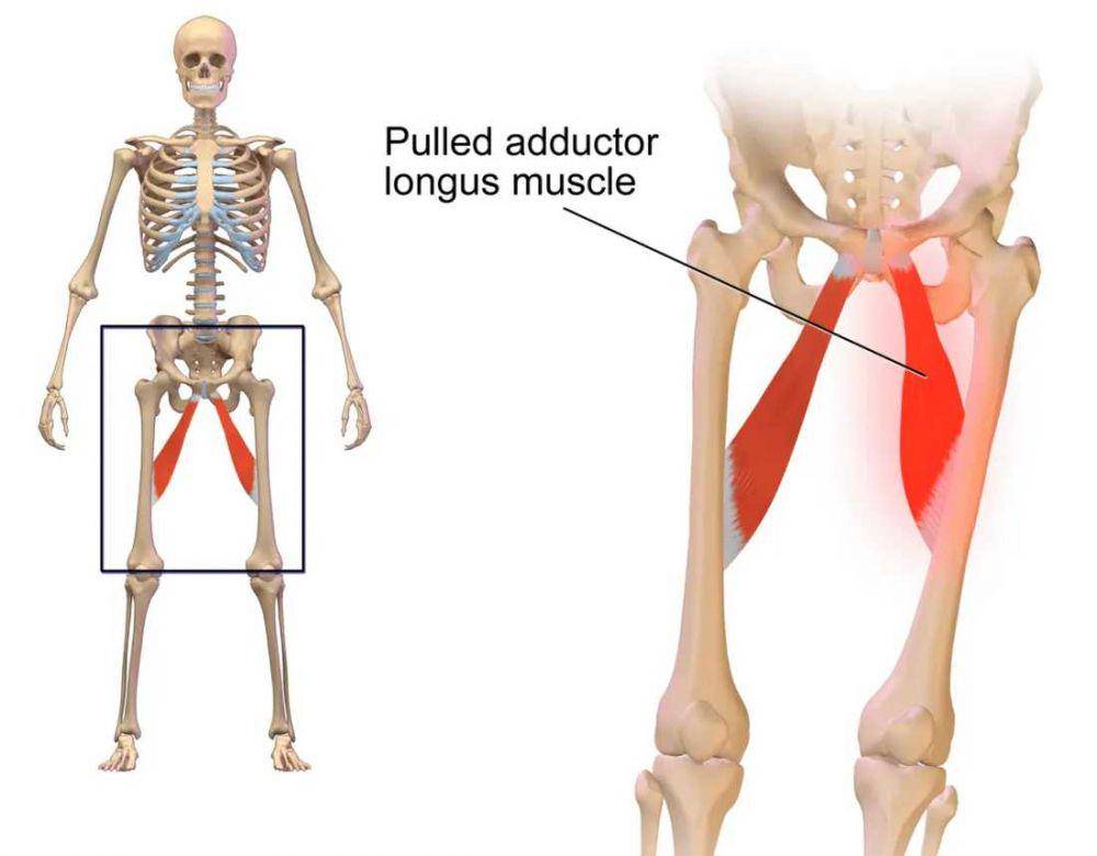 ilustrasi groin strain (medicalnewstoday.com/Bruce Blaus)