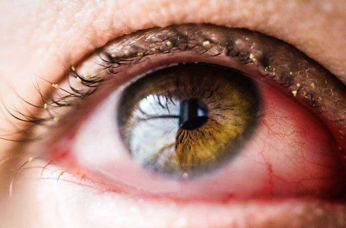 ilustrasi konjungtivitis atau pink eye (allaboutvision.com)