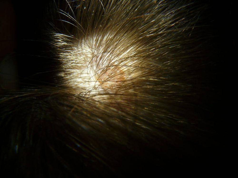 ilustrasi ringworm pada kulit kepala (pixabay.com/Hans)