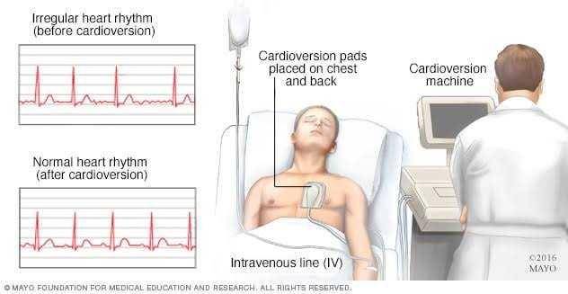 ilustrasi kardioversi (mayoclinic.com)
