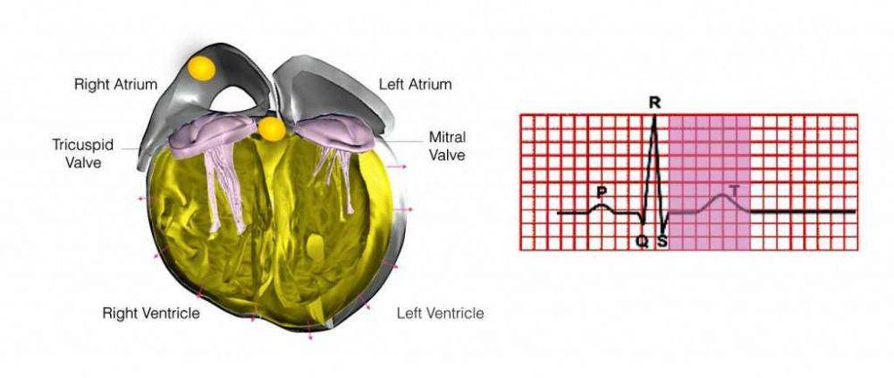 ilustrasi atrial flutter (onehearthcardiology.com)