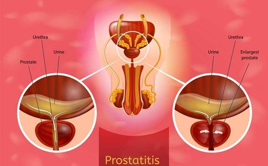 ilustrasi prostatitis (rossmoskowitzmd.com)