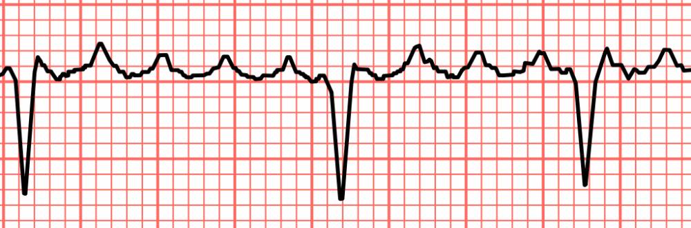 ilustrasi detak jantung pada atrial flutter (commons.wikimedia.org)
