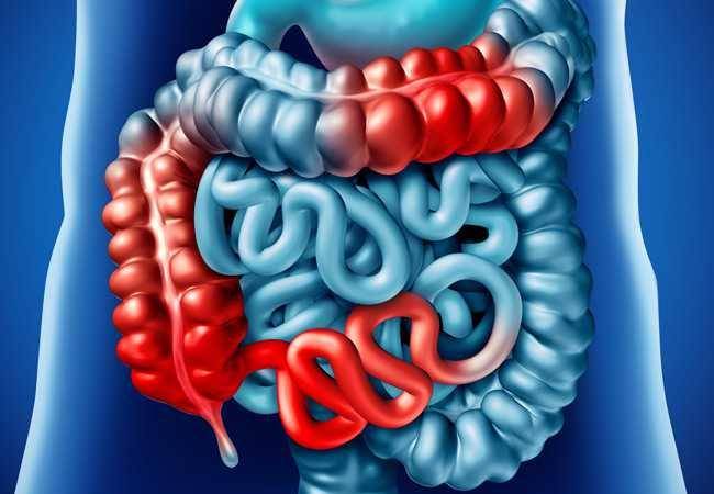 ilustrasi penyakit Crohn (clevelandclinic.org/Anthony DeRoss)