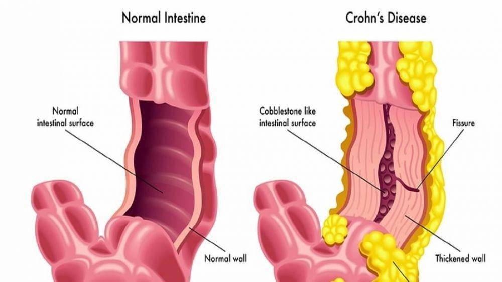 ilustrasi penyakit Crohn (nationalheraldindia.com)